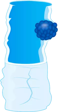 Стадия 3