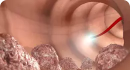 Что такое плохая очистка кишечника?