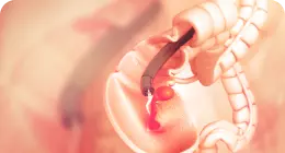 Как проходит колоноскопия?