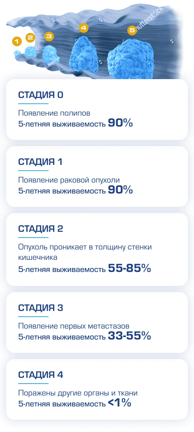 Колоректальный рак проходит несколько стадий развития